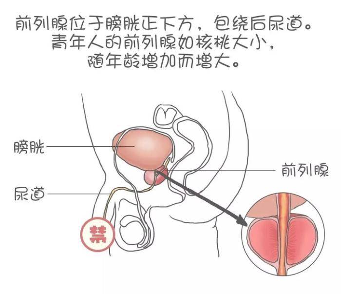 前列腺增生病人图片