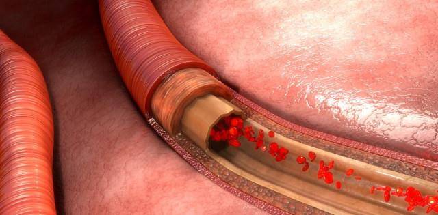 怎么知道自己的血管堵了 88df6af7506f4fc5b2144a88cf4f96c0.jpeg