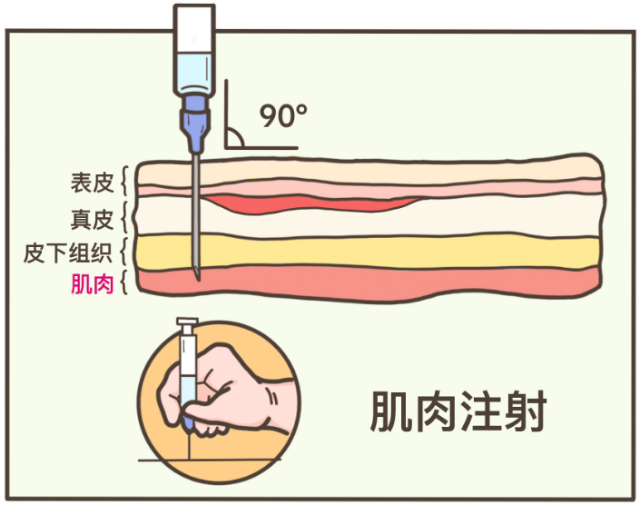 肌肉注射简易图图片