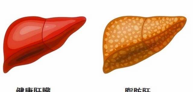 喝什么降甲胎蛋白最快 4cd53ce6b730439ebd92bed8ab5d9de7.jpeg