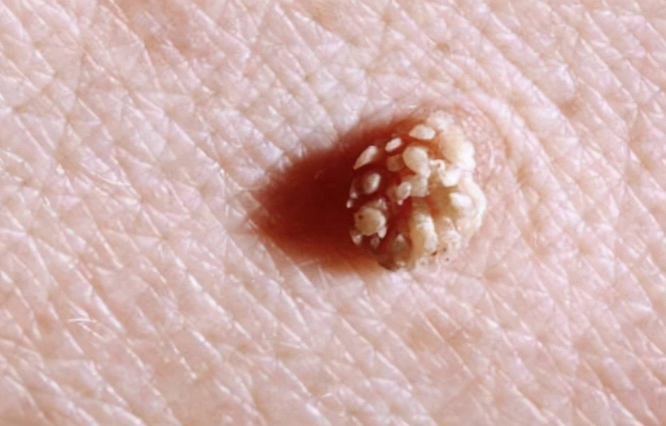 菜花状的"疙瘩",此时不要误以为是过敏,多半是感染hpv之后引起的疣体