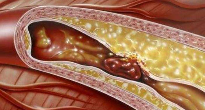 吃什么东西可以补低密度脂蛋白呢 faef50192442434bad0bd92da7737ae2.jpeg