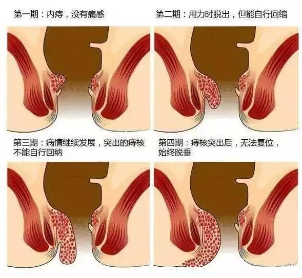 痔瘡只是偶爾便血但是不疼也不癢可以不治嗎