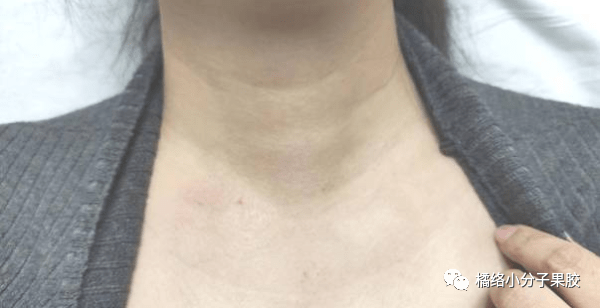 女性要特别留意甲状腺结节比男性高3倍