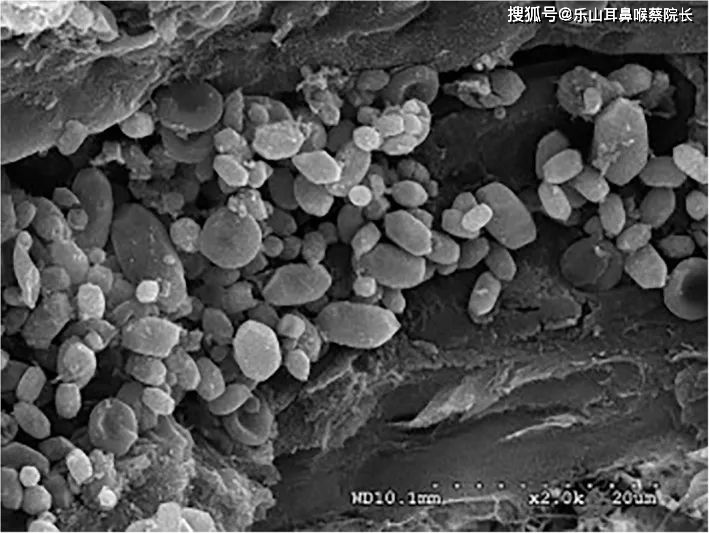 它跟胆结石一样吗? 是耳朵里长石头了吗?
