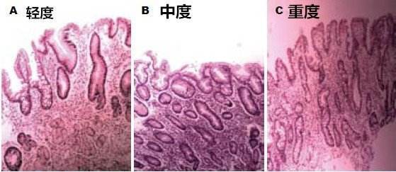 肠化生的三种程度