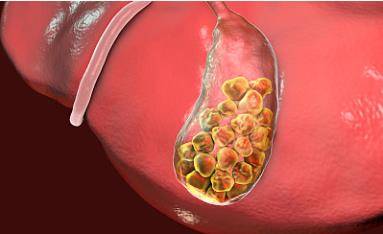 尿路结石的复发率很高,男性百分之百女性也有百分之五十,要预防