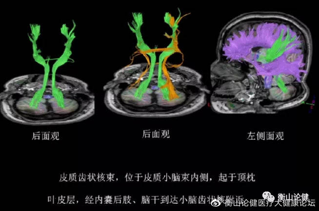 纖維的最外層,經內囊下行,繞過腦橋前方到達對側小腦半球脊髓小腦束