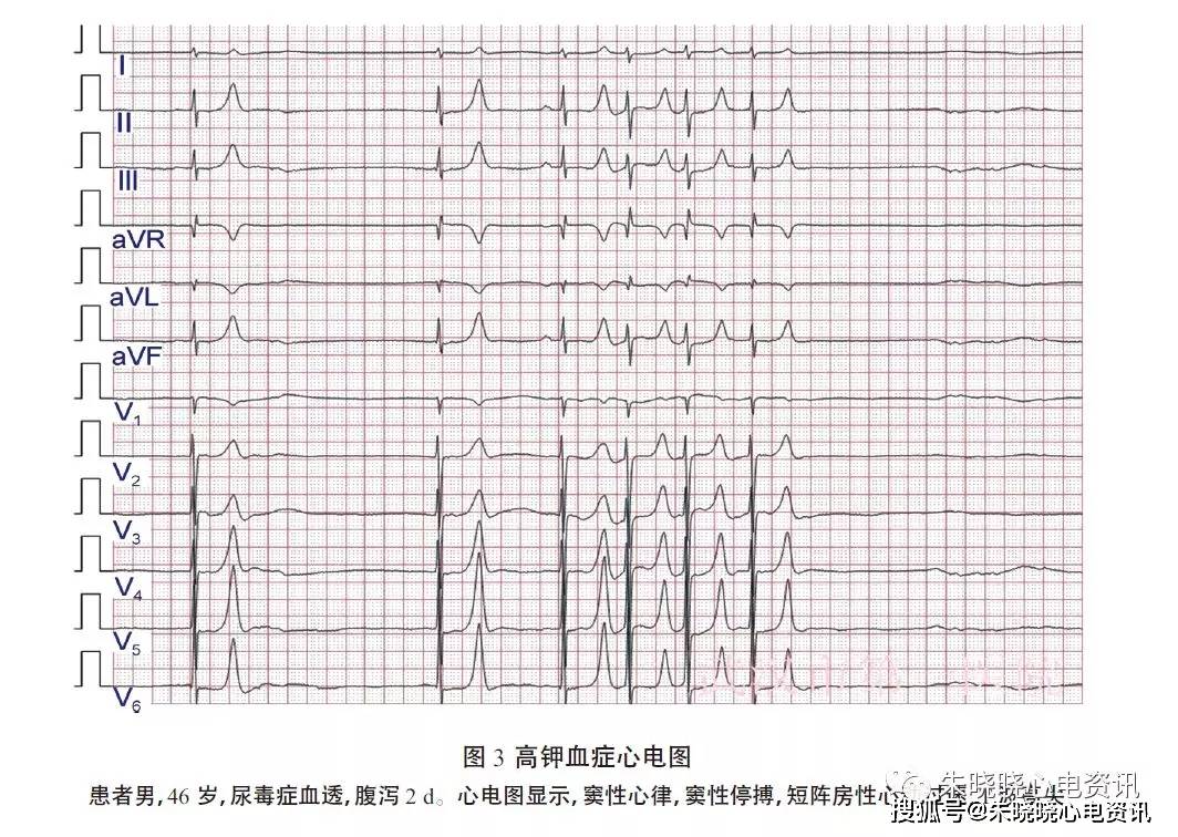 高钾血症心电图