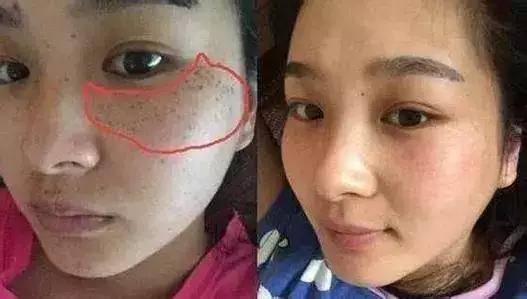 面部有斑也许正是反映身体某部位发生妇科疾病的初期症状,女人应提高