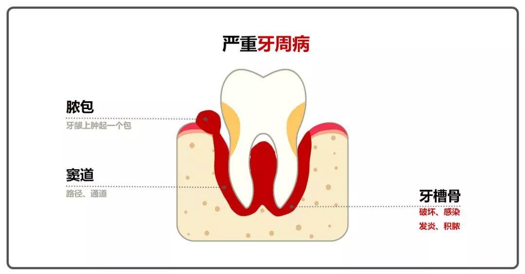 牙龈长脓包?请做到“二不一要”!
