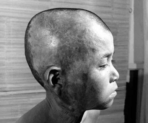 弹幸存者,其中一个亲历者谷口晔背部皮肤被原子弹高温烫伤,爆炸还导致