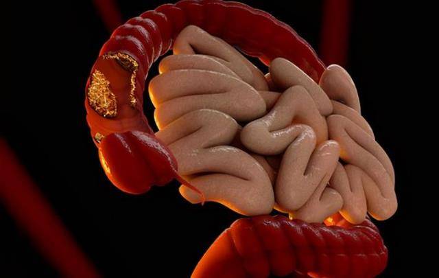 大便|肠道出现异常，身体不会静悄悄，3个表现早发现，别拖别大意