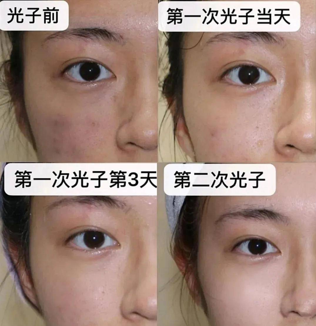 血管|光子嫩肤、皮秒、水光针怎么选？看完你就知道了