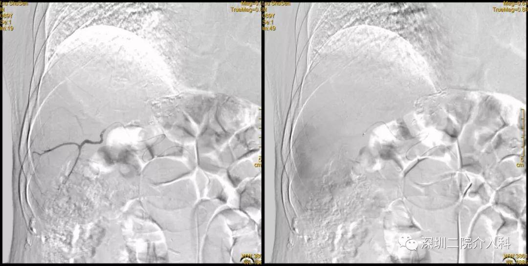 患者|高龄患者得肝癌就要放弃治疗？介入医生说“NO”！