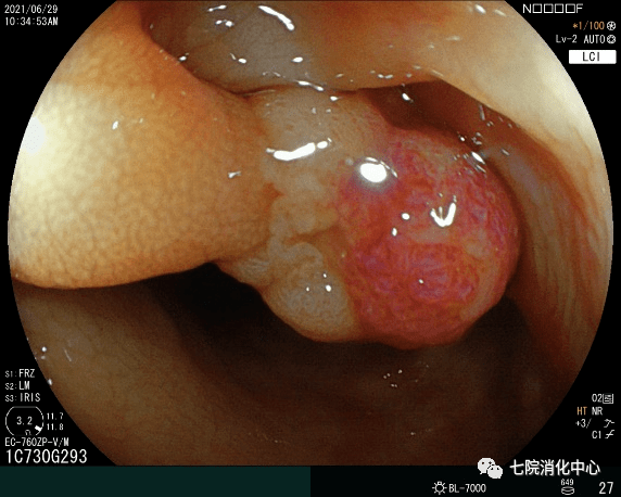 手术|结肠息肉怎么破？内镜帮您来搞定
