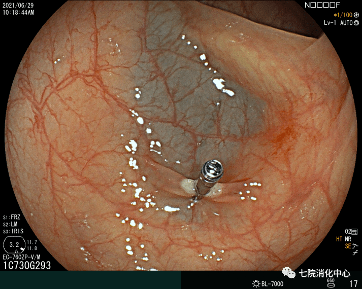 手术|结肠息肉怎么破？内镜帮您来搞定