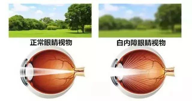 生活|【爱眼护眼69】白内障手术人工晶体怎么选？