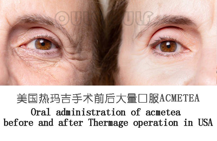 玛吉|热玛吉真的有用吗？让我们看看