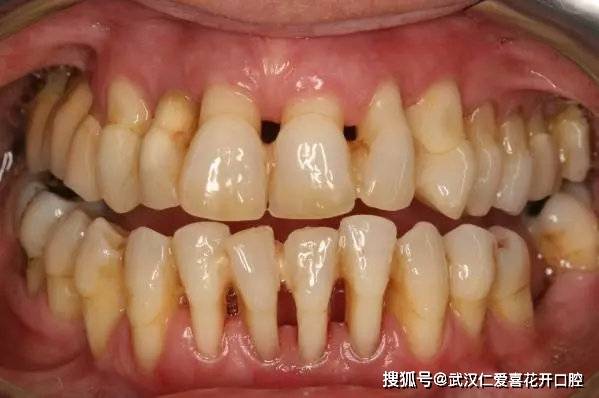戴套必知丨人人都怕的黑三角,学会这招能轻松避免_牙齿
