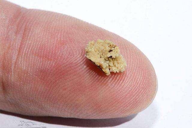 肾结石怎么得的 来自搜狐网