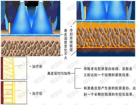 玛吉|热玛吉效果咋样，传言太乱!!亲测到底热玛吉效果怎么样?