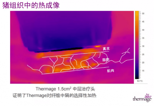 mm|超声刀强势来袭，热玛吉还能占据抗衰c位？