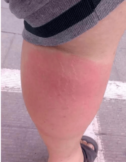 头疼恶心是新冠症状吗_头疼恶心新冠症状怎么缓解_ - 知财网