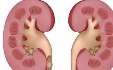 尿酸|夏季是肾结石易发生的季节，不想得结石，这些习惯要改改了