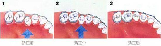 轮廓|圣嘉新邱立东：带牙套会影响改脸型手术吗？