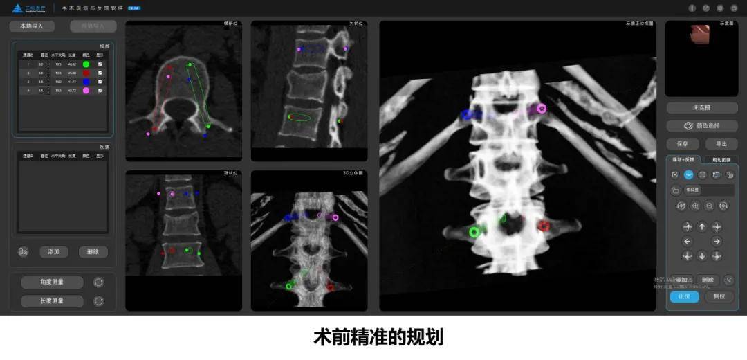 辅助|西安市中心医院老年骨科中心成功完成医院首例导航机器人辅助下脊柱手术