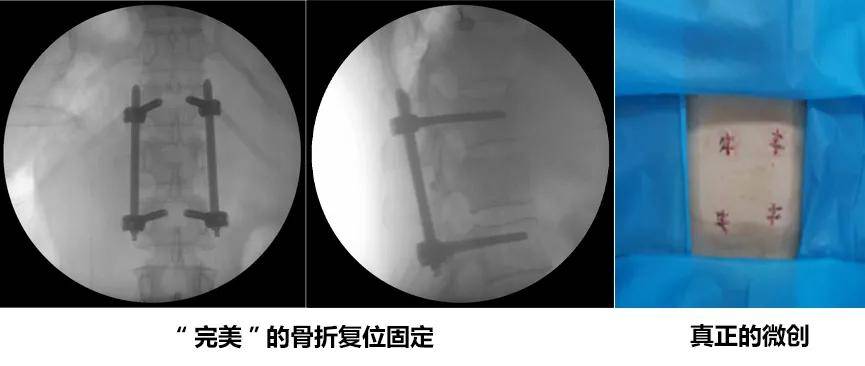 辅助|西安市中心医院老年骨科中心成功完成医院首例导航机器人辅助下脊柱手术