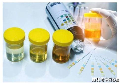 综合征|过敏性紫癜肾炎怎么才算痊愈?肾炎会影响正常生育吗?