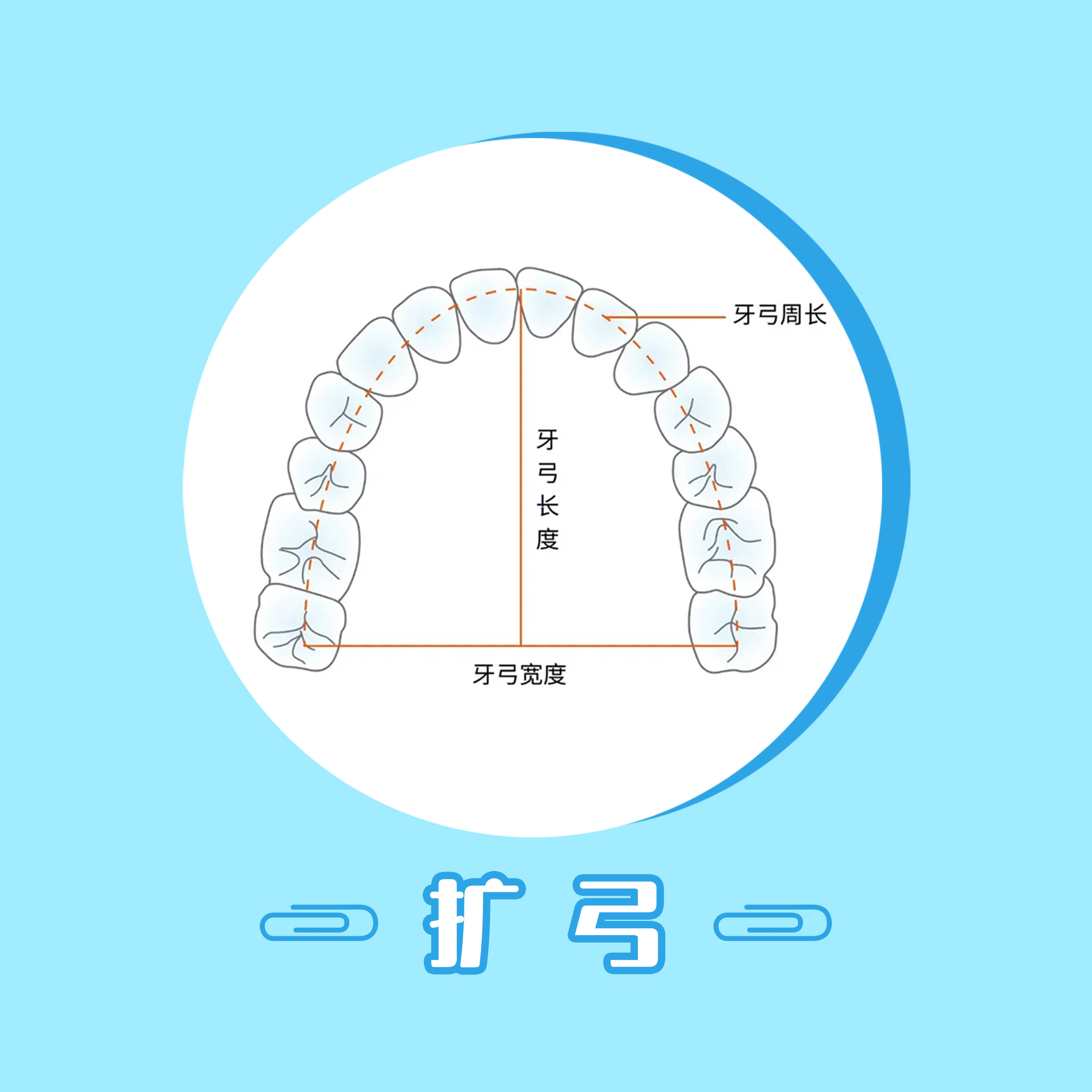 【扩弓】也就是扩大牙弓,前牙扩弓,适合牙弓长度不足且嘴突不明显的