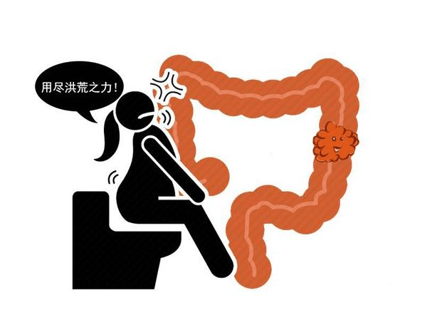 大便|大便“先硬后软”,是肠癌来临?医生:别慌,4个因素先搞清楚!