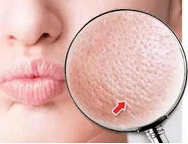 怎么解决毛孔粗大的问题 236254ef06c2439c81a102a8eb014eca.png