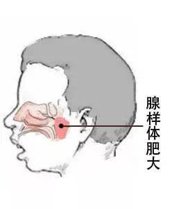 如何簡單自測孩子是否患有腺樣體肥大