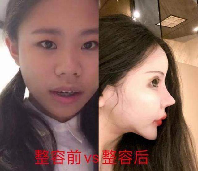 13岁女孩“整容上瘾”3年整了60多次如今“画风”不忍直视(图6)