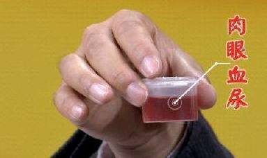 造血|肾病就是肾痛?错!身体出现这4种情况可能就是肾在求救