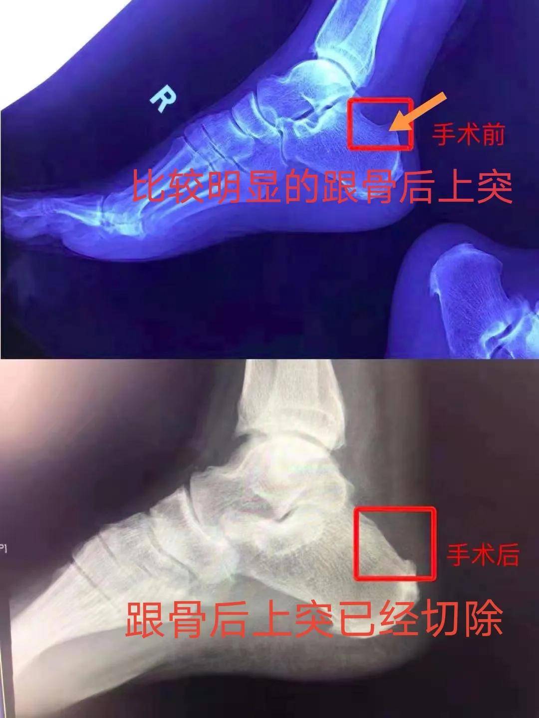 Haglund|这种足跟痛是怎么回事？——跟骨后上突过大引发的Haglund病