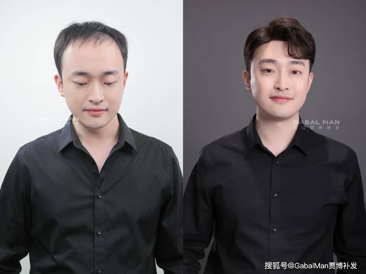 假发|地中海发型和戴假发，你更不能接受哪个？