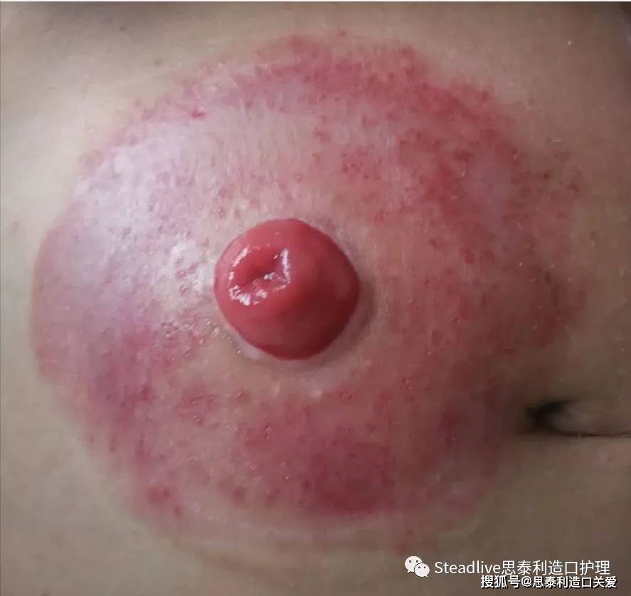 造口周围皮肤出现红痒肿痛怎么办