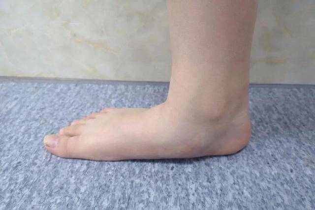 进行|女人脚上出现这5个表现，或能说明什么呢？不妨来了解了解