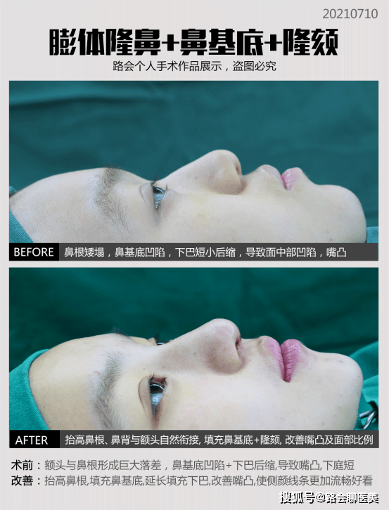 整形|听说膨体垫鼻基底后一辈子不能笑，这是真的吗？