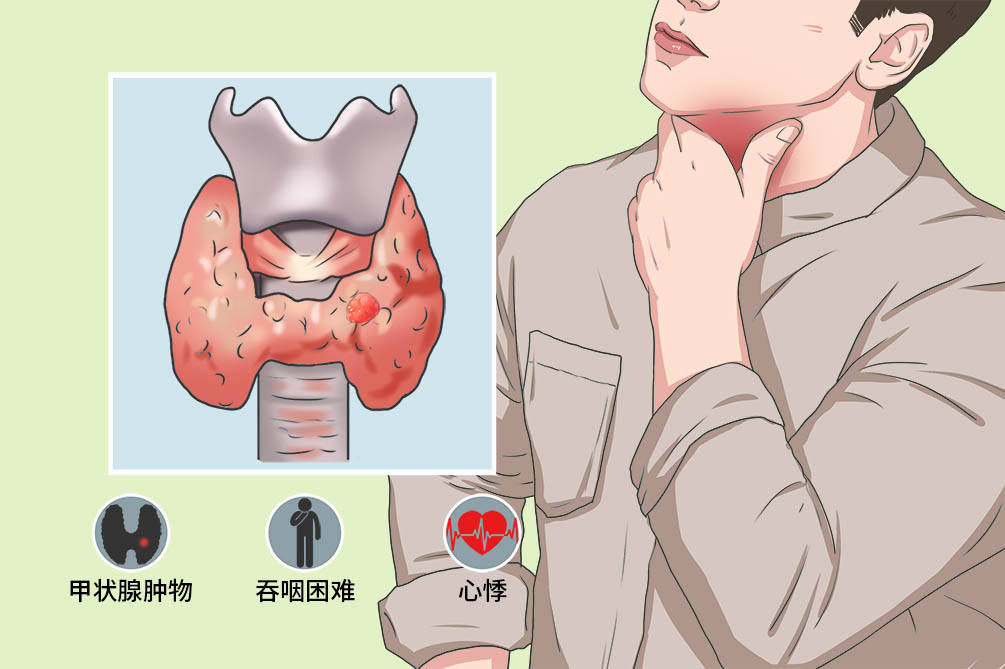 景录先医生分享 带你了解甲状腺微小癌 一 发病