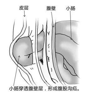 给予|医者解读 | 关于腹股沟疝你知道多少?