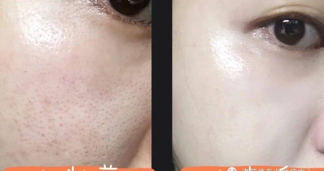 姐妹|痘痘肌化妆教程，小心机已经收藏了！