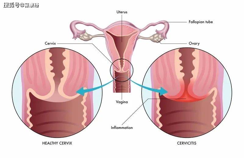 IMMsight|普康裕|IMMsight免疫量化与疾病风险评估再添新病种!