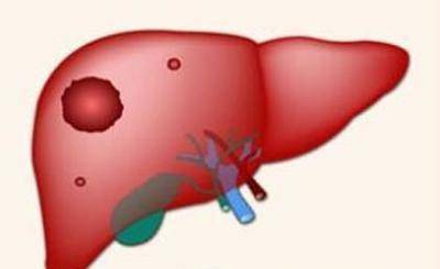 肝脏|肝病来袭并非“静悄悄”！这4类人，还是建议多多检查肝脏