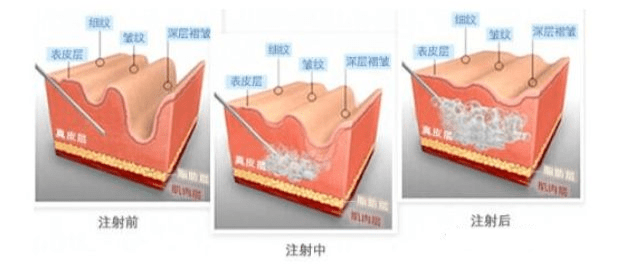 密码|爱兰诗 | 祛皱除皱的神奇密码 —— 阿基瑞林